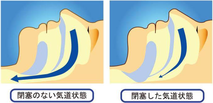 睡眠時無呼吸症候群よくある質問